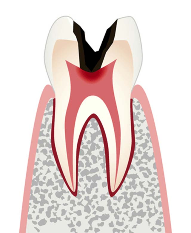 歯の神経まで達したむし歯