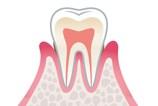軽度歯周病